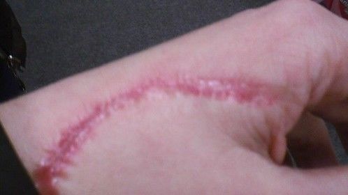 hand scar