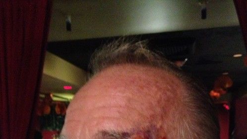 Jackie Martling bruising